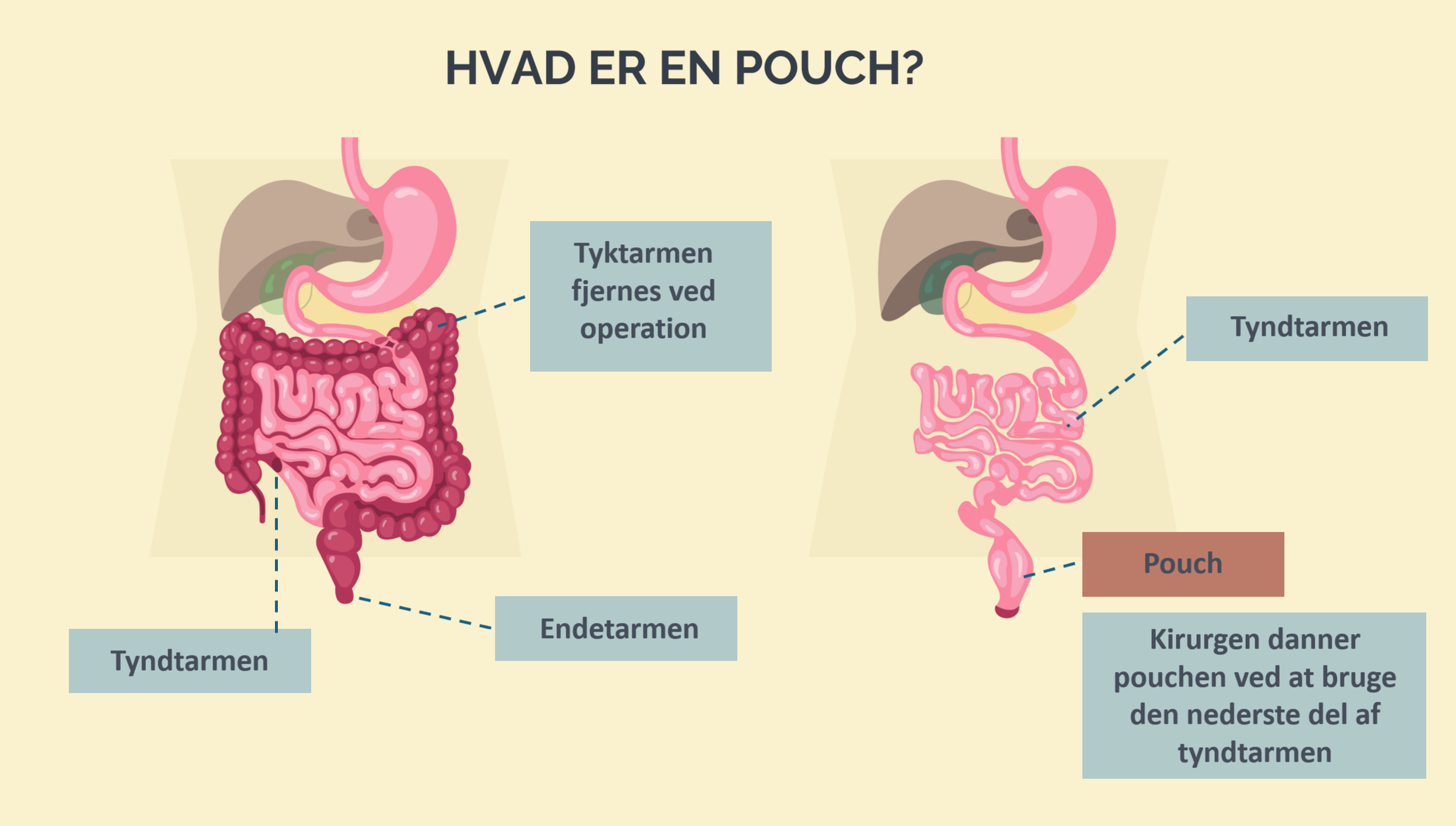 Pouchitis